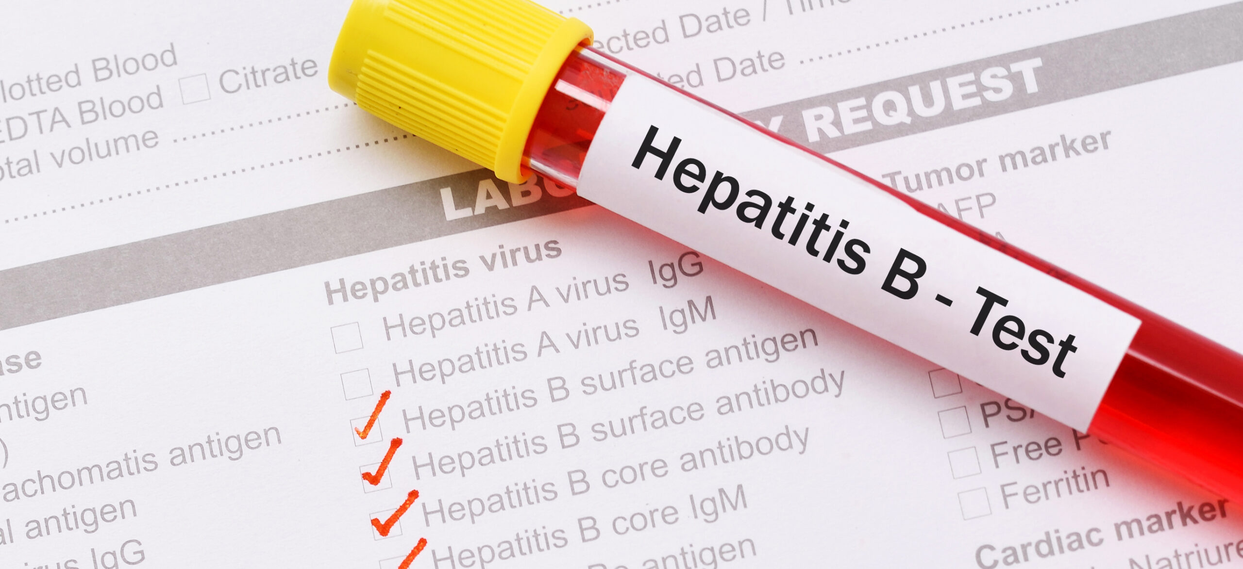hepatitis B