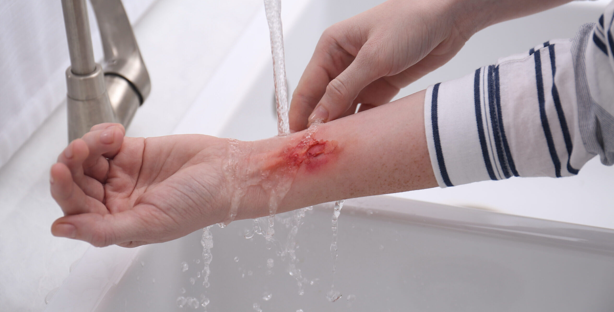 first-aid care for minor burns