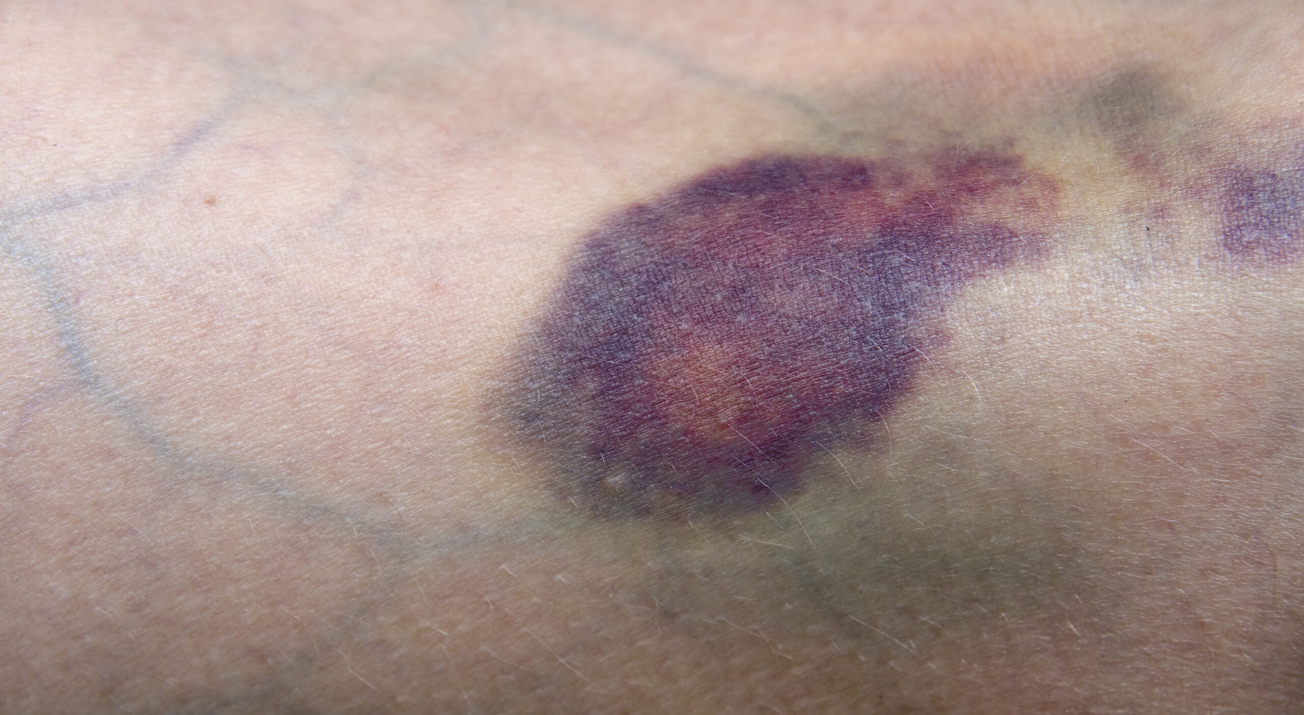 first-aid care for contusions and bruises